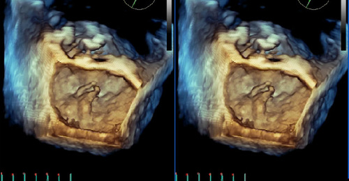 Vivid E9: 4D Imaging Optimization