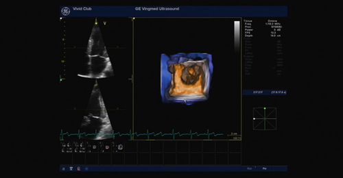 Vivid E9: Basic 4D Acquisition - Morphology