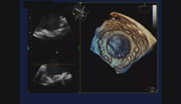 Webinar: Elevating the Power of Ultrasound featuring Bijoy K. Khandheria