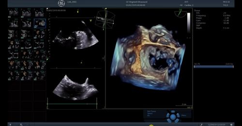 CT Fusion - Echo Alignment and Review Registration