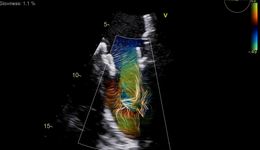 Blood Speckle Imaging White Paper