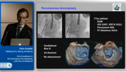 Euro Echo 2016: Echo Guidance in Percutaneous Annuloplasty with the Cardioband feat. Felix Kreidel