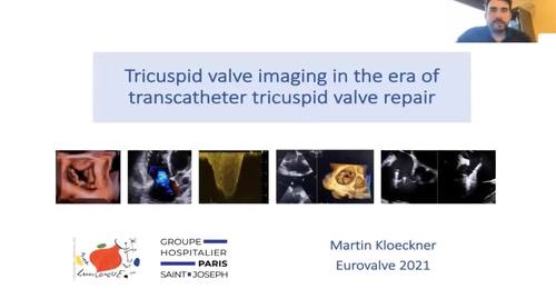 Tricuspid valve imaging in the era of transcatheter tricuspid ...