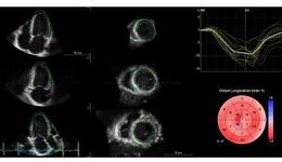 4D Strain - A Clinical Viewpoint
