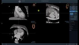 CT Fusion - CT Alignment