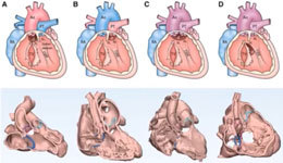 4D echocardiography in CHD